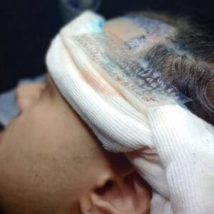 hair transplant